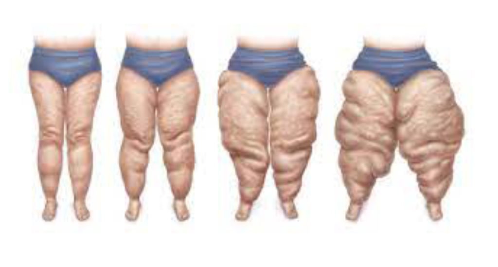 Lipo lymphedema stages treatments therapy explained